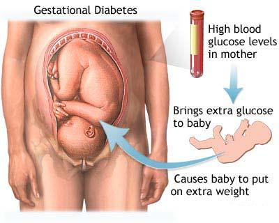 Gestational diabetes