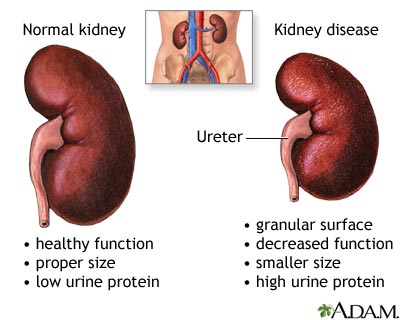 The number one cause of kidney disease in the world is due to complications from diabetes.