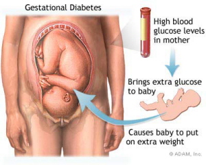 Glucose challenge test for gestational diabetes.