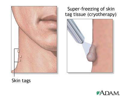 Picture of skin tags (acrochordons) Picture of skin tags (acrochordons)