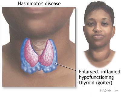 Hashimotos thyroiditis
