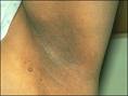 Picture of acanthosis nigricans in the arm pit