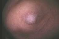 Picture of acanthosis nigricans on the elbow