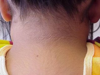Acanthosis nigricans on the nape of the neck