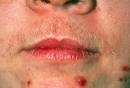 Adult acne and excess facial hair on women can be a sign of a serious metabolic disorder.