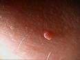 Picture of Skin Tag