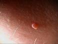 What are skin tags? Picture of Skin Tag