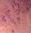Skin tags can be a sign of prediabetes and insulin resistance.