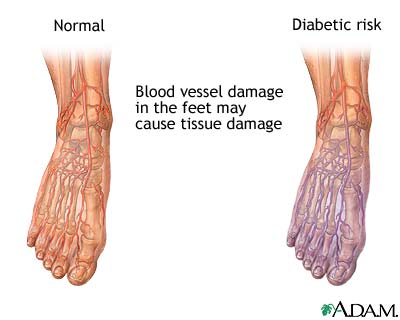 High blood sugar can cause damage to nerves throughout the body, causing numbness in extremities, poor circulation and even damage to nerves in the digestive tract causing a condition known as Gastroparesis. Neuropathy can be caused by high blood sugars.