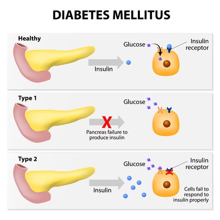 Diabetes Mellitus Types