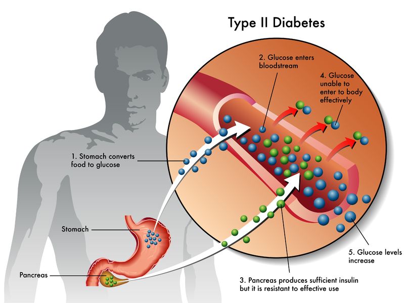 Type II Diabetes Diagram