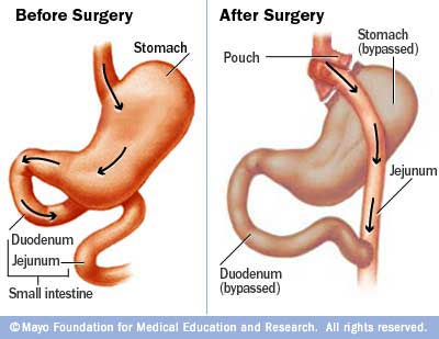 Gastric bypass surgery